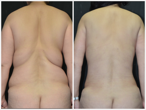 Before & After Image - posterior
