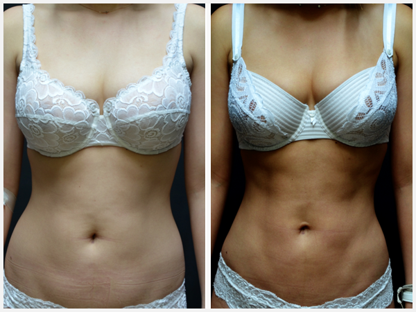 Before & After Image - body