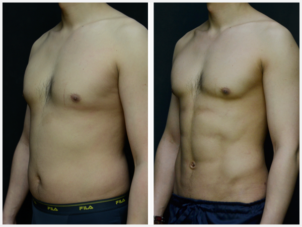 Before & After Image - gynecomastia