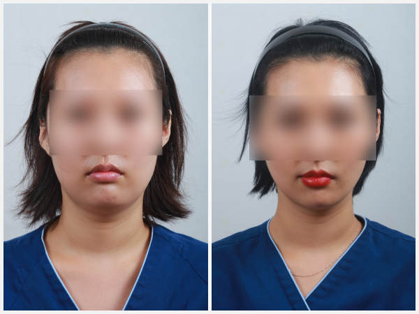 Before & After Image - Face