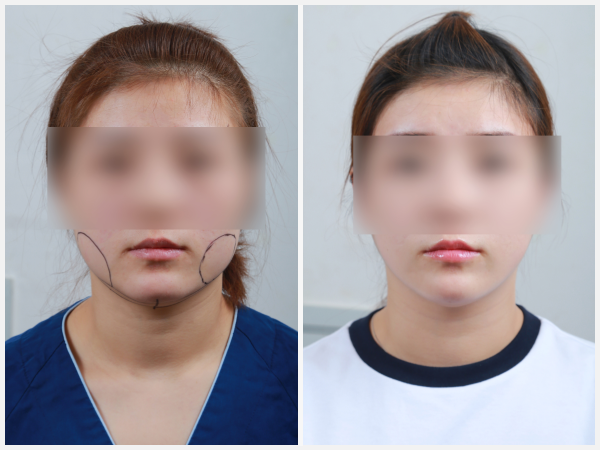 Before & After Image - Face