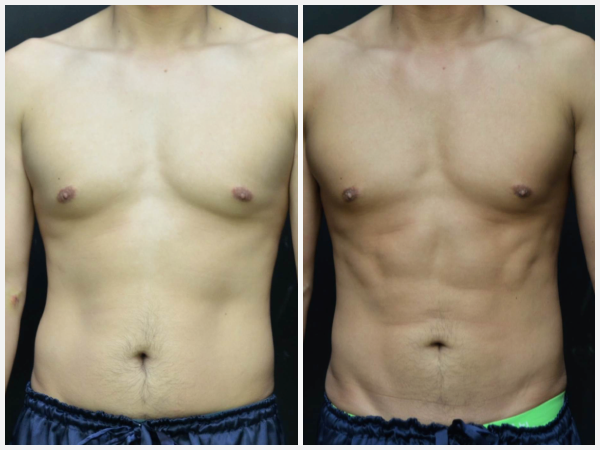 Before & After Image - body