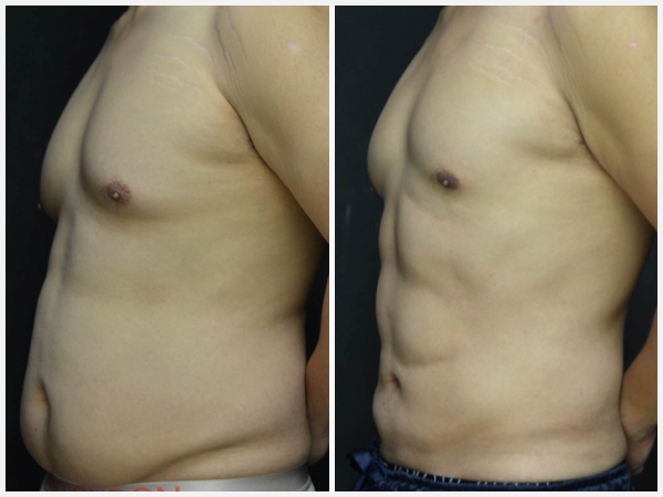 Before & After Image - gynecomastia